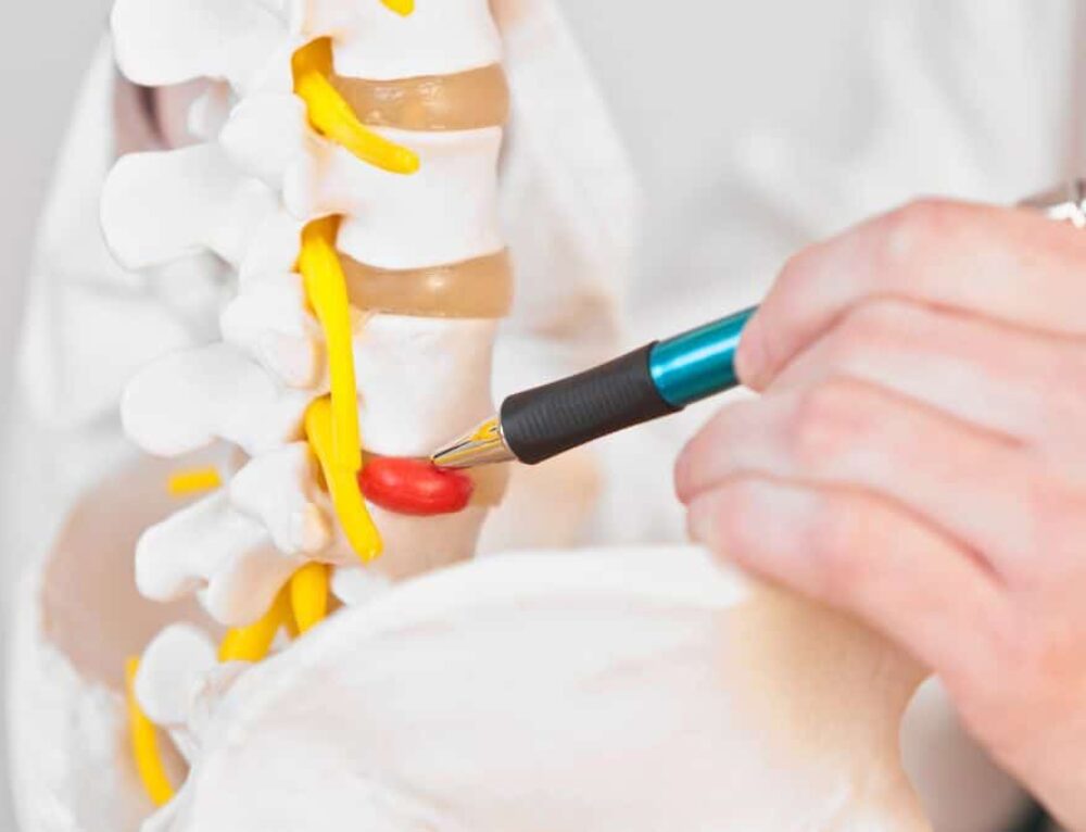 How To Sleep With a Herniated Disc 4 Best Sleeping Positions