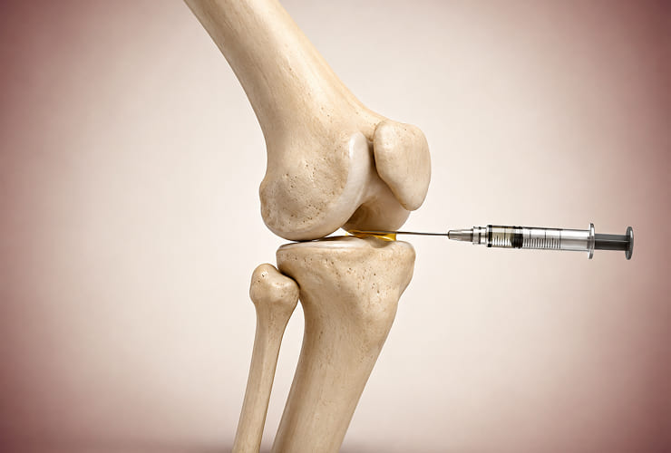 Knee injection procedure illustration
