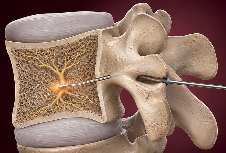 Basivertebral nerve ablation procedure illustration