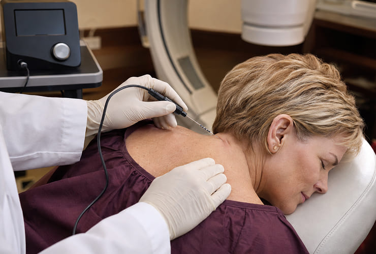 Cervical radiofrequency neurotomy procedure illustration
