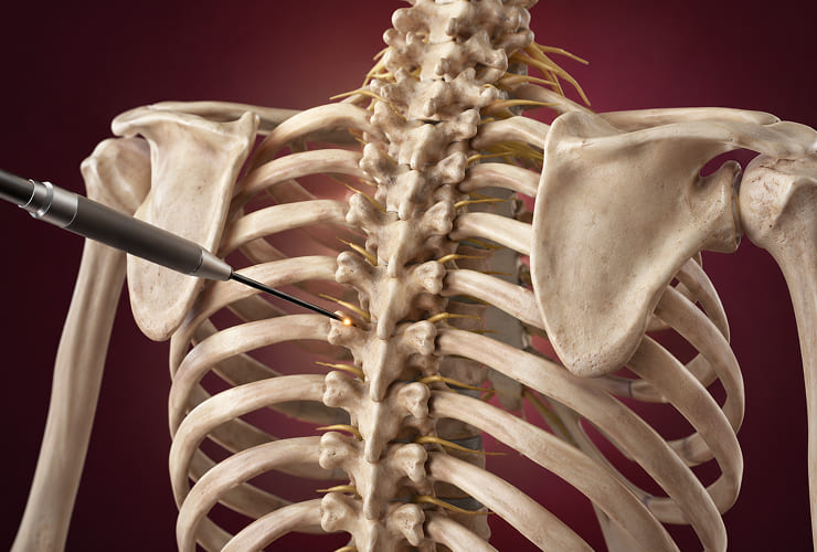 Thoracic radiofrequency neurotomy procedure illustration
